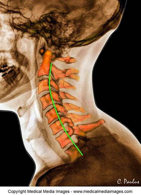 A Normal Neck Curvature Chiropractic Lordosis Shown By Green Line