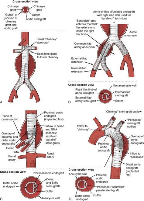 Thoracic Endovascular Aortic Repair With The Chimney Graft Technique