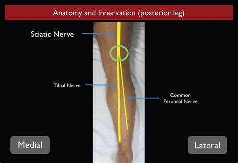 How To Perform Ultrasound Guided Distal Sciatic Nerve Block In The