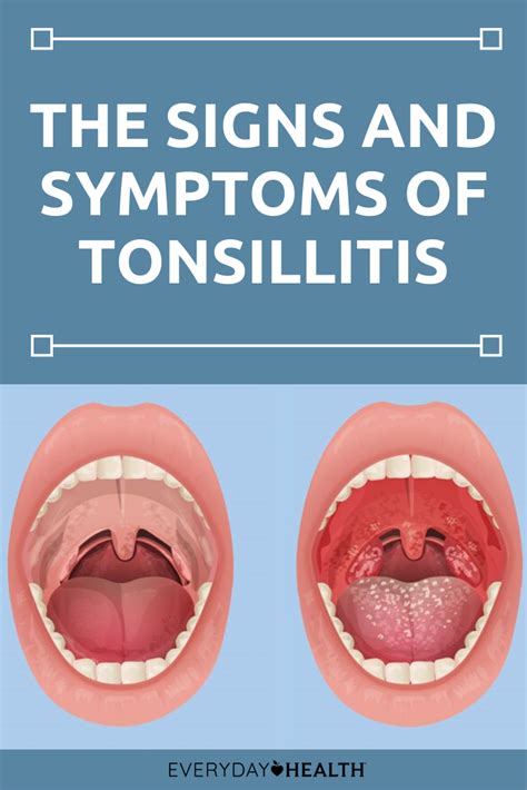 How does oral hpv cause head and neck cancer? How Do You Know if You Have Tonsillitis? | Symptoms of ...