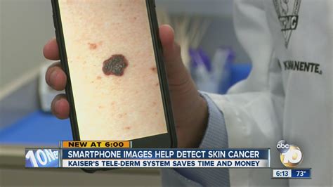 Selfies Smartphones And Skin Cancer Videos