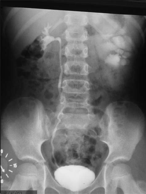 Intravenous Pyelography Reveals Left Hydronephrosis Without