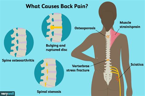 COMMON CAUSES OF BACK PAIN