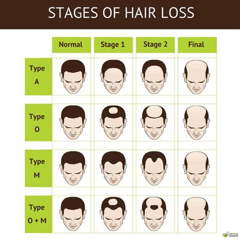 How To Determine The Type Of Baldness You Have Justinboey