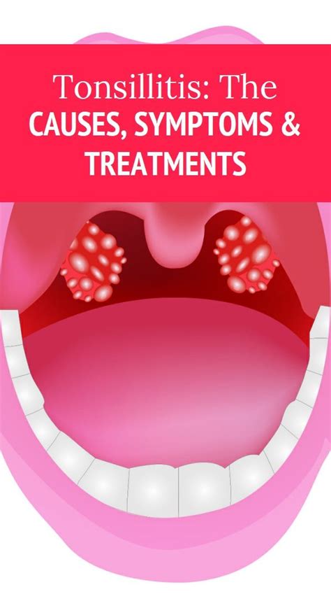 Tonsillitis The Causes Symptoms And Treatments Health Knowledge