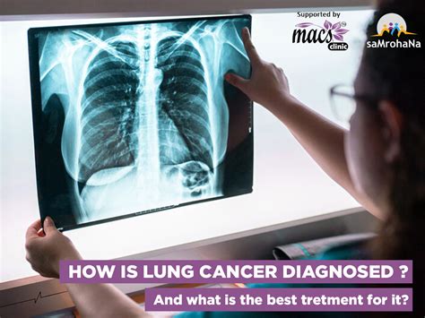 Diagnosis Of Lung Cancer And The Best Way To Treat It Macs Blogs