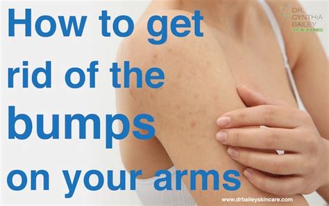 How To Get Rid Of Chick Skin Bumps On Your Arms Keratosis Pilaris