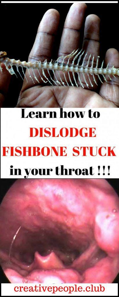 Learn How To Dislodge A Fish Bone Stuck In Your Throat Creative