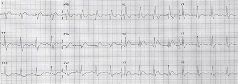 Ekg Stemi Locations