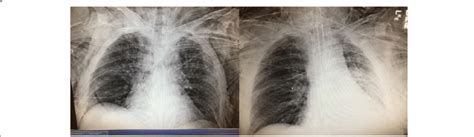 Progression Of Preoperative Chest X Ray Findings Showing An Evolving