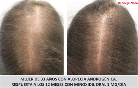 Alopecia Androgénica Femenina Premenopausica Mujeres Pérdida De Pelo