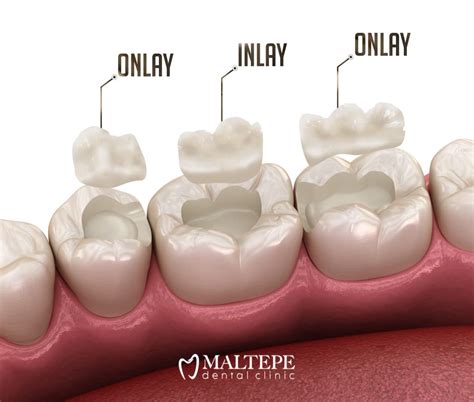 Composite Inlays And Onlays A Durable And Affordable Option Maltepe