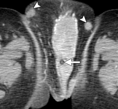 Imaging Of The Female Perineum In Adults Radiographics