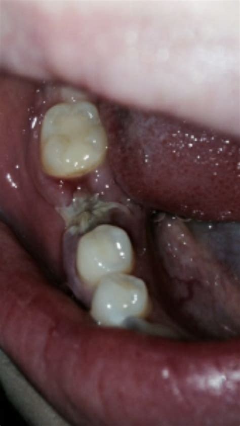 List Of How To Tell If A Wisdom Tooth Is Infected References