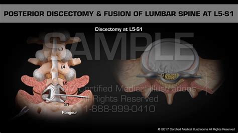 Posterior Discectomy And Fusion Of Lumbar Spine At L5 S1 Youtube