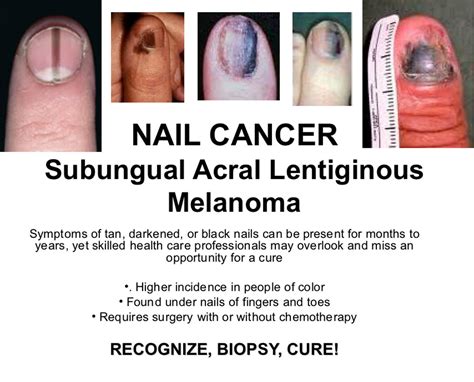 Symptoms Of Skin Cancer Under Nail Share News About Nail