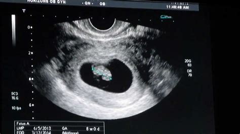 What Does A Baby Look Like At 8 Weeks Ultrasound Baby Viewer