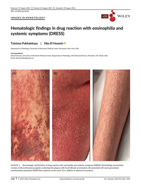 Hematologic Findings In Drug Reaction With Eosinophilia And Systemic