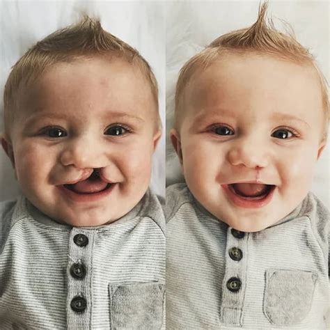 Cleft Lip And Cleft Palate Two Week Surgery 9gag