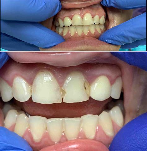 How Do Dentist Fill Cavities Between Teeth