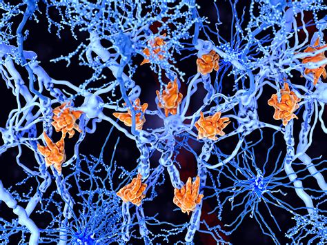 Conversations about support, research, drug therapies, nutrition, exercise,. Scientists make new discovery in search for multiple ...