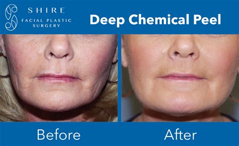 Deep Chemical Peels Before And After Shire Facial Plastic Surgery