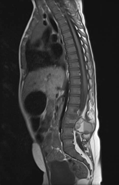 Spine Aneurysmal Bone Cyst Image