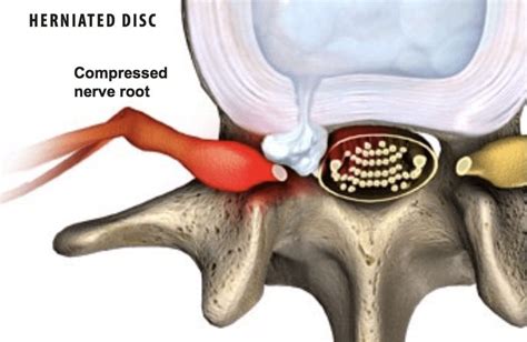 Lumbar Herniated Disc Lumbar Herniated Discs And Their Symptoms