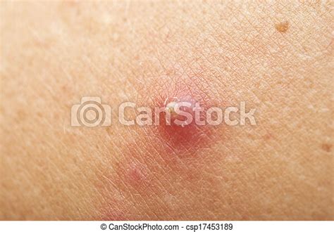 Pimple Extreme On Human Skin Macro Canstock