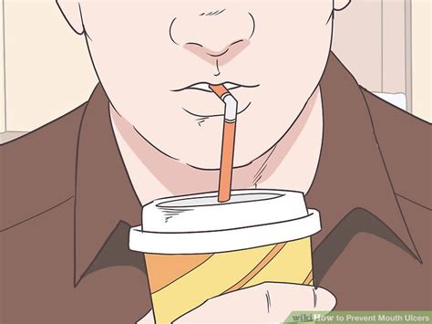 4 Simple Ways To Prevent Mouth Ulcers Wikihow