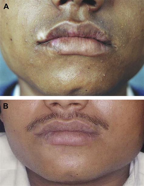 White Spots On Lips Vitiligo