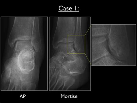 Ap And Mortise View Of The Left Ankle In Case 1 With Enlarged Focus On