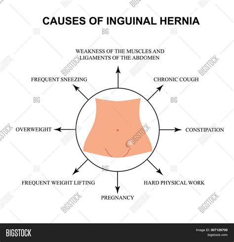 Causes Inguinal Hernia Image And Photo Free Trial Bigstock