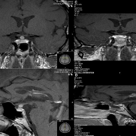 Preoperative T1 Weighted Gadolinium Enhanced Dynamic Coronal A And