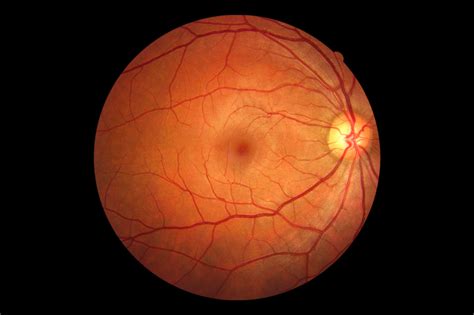 Associated Retina Consultants What Causes Retinal Tears And