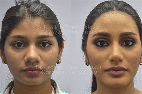 ‘before And After Surgery Photos Of Miss Universe Venezuela Go Viral