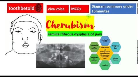 Cherubism Detailed Fibro Osseous Lesions Oral Pathology Neet Mds