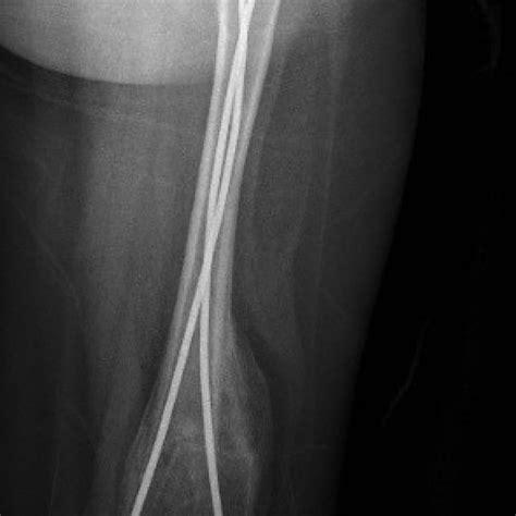 Radiograph Of Left Femur Of The Male Sibling Showing A Healed Femur