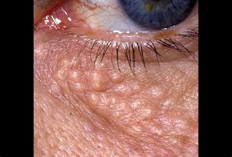 Pictures Of Skin Diseases And Problems Syringoma