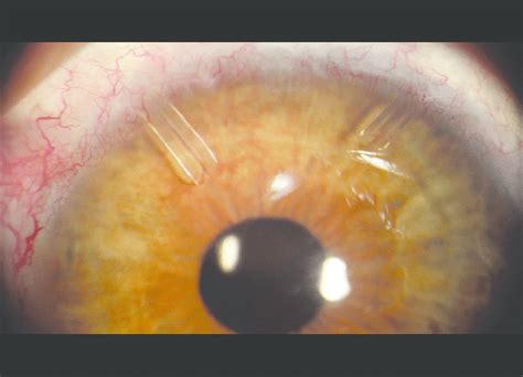 The Right Eye Of A Patient With The Second Ahmed Glaucoma Valve