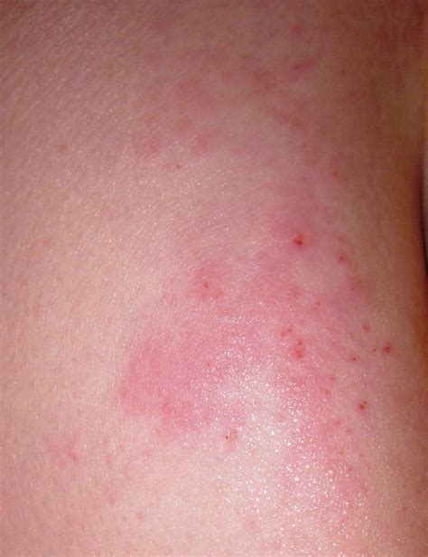 Early Rash Shingles Pictures Onset Search Results Dunia Photo