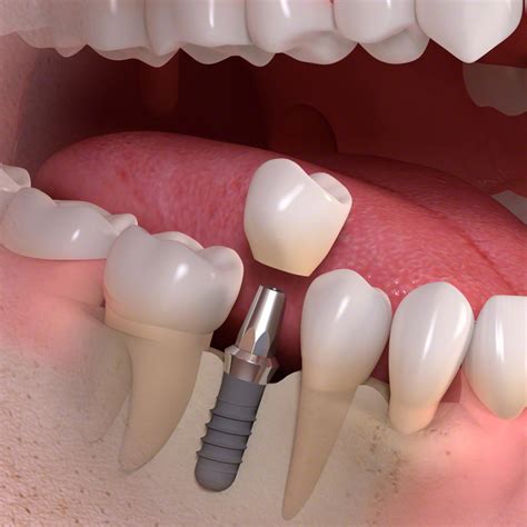 Single Tooth Implant Restoration Apco Dental Care