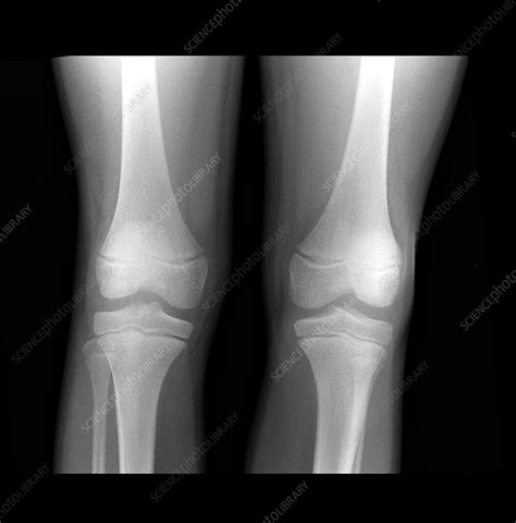 Normal Pediatric Legsknees X Ray Stock Image C0034576