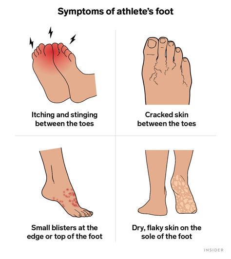 Causes And Symptoms Of Athletes Foot Ask The Nurse Expert
