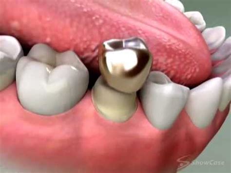 Check spelling or type a new query. Dentist - Tooth Restoration Treatments - YouTube
