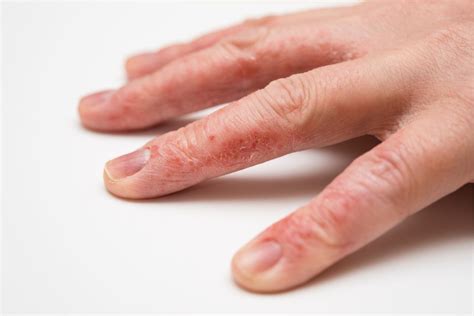 Peeling Fingertips Causes And Treatment Wantz Details