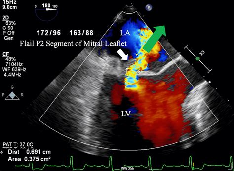 Cureus Mitral Leaflet Flail As A Late Complication Of Infective
