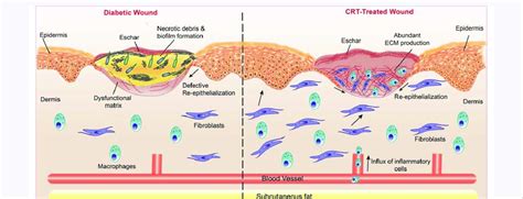 Calreticulin Crt Ameliorates Most Defects In Diabetic Wound Healing