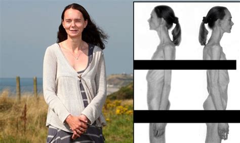 Shocking Pictures Show How One Woman Succumbed To Anorexia Eating Just