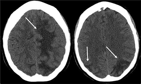 Frontiers Posterior Reversible Encephalopathy Syndrome Pres